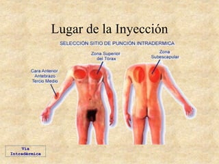 Lugar de la Inyección
Vía
Intradérmica
 