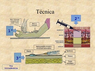 Técnica
1º
2º
3º
Vía
Intradérmica
 