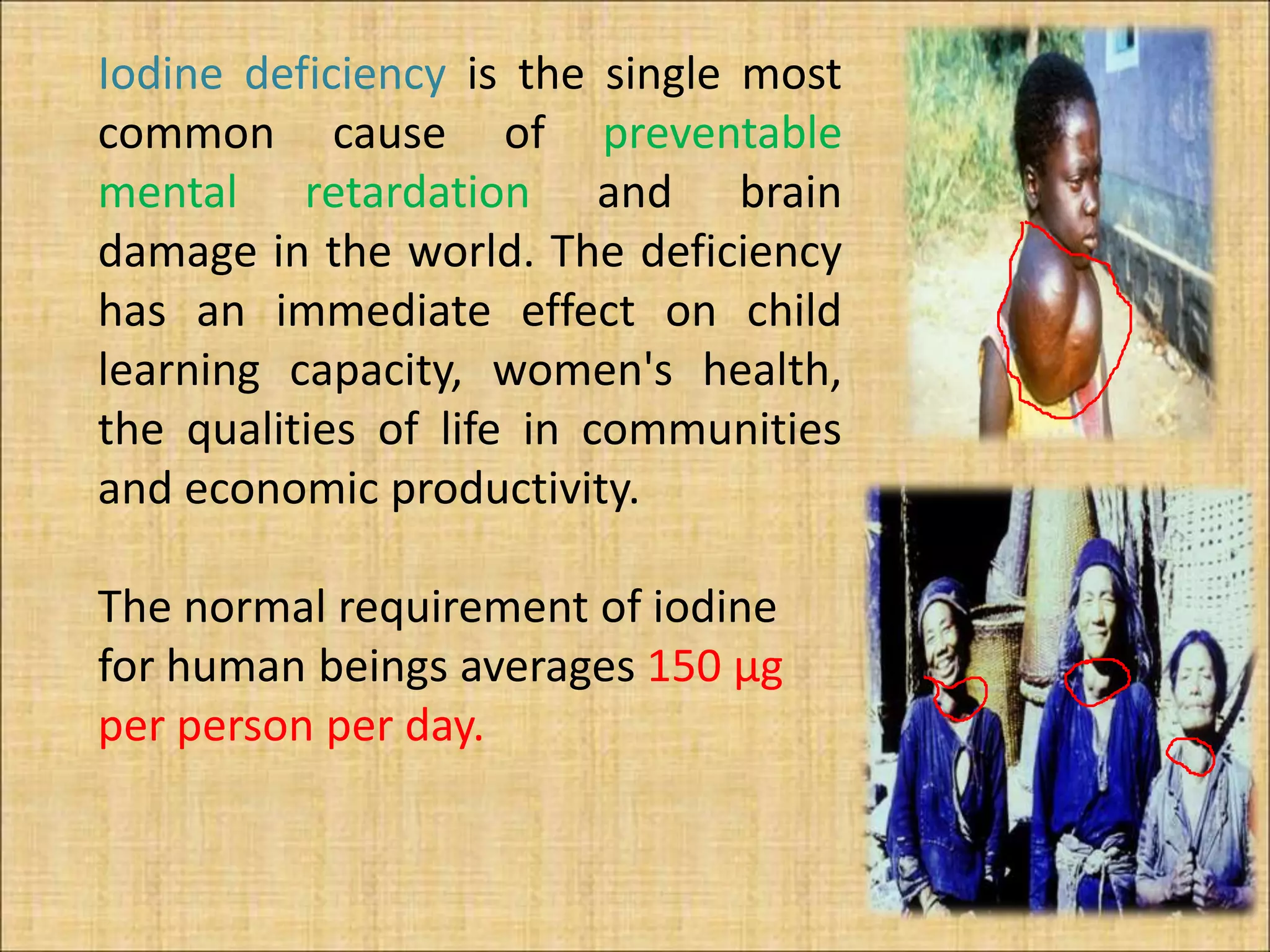 Iodine deficiency disorder | PPTX