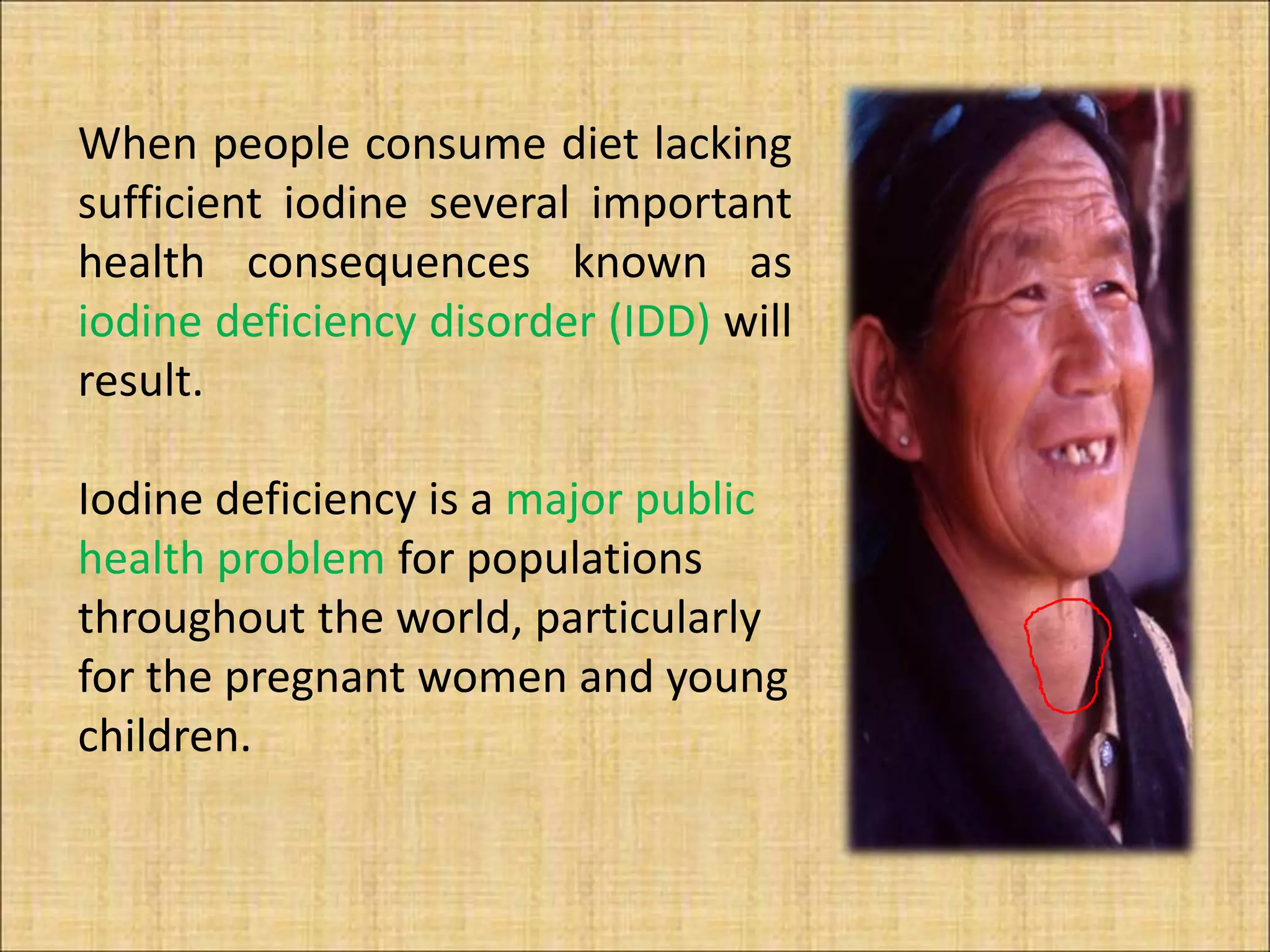 Iodine deficiency disorder | PPTX