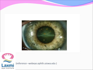 (reference –webeye.ophth.uiowa.edu )
 