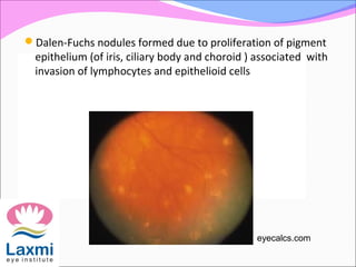 Dalen-Fuchs nodules formed due to proliferation of pigment
epithelium (of iris, ciliary body and choroid ) associated with
invasion of lymphocytes and epithelioid cells
eyecalcs.com
 