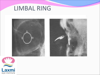 LIMBAL RING
 