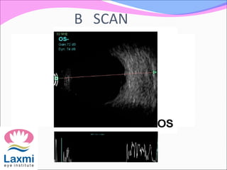 B SCAN
 