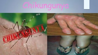Chikungunya
 