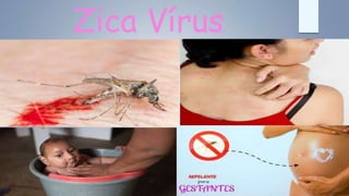 Zica Vírus
 