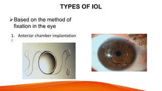 Iol Types Intaoccular lens | PPTX