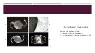 IOL calcification ( hydrophillic):
A,B: on the surface of IOL.
C : within the IOL substance.
D: on the posterior surface of silicon IOL
.
 