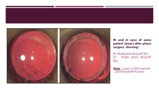 Rt and Lt eyes of same
patient 3years after phaco
surgery showing :
Rt: Multipiece Acrysoft IOL.
Lt: Single piece Acrysoft
IOL.
Note : eht
ssel
OCP
ni
esac
esac
fo
eceipitluM
LOI
.
 