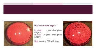 PCO in A Round Edge :
Rt photo 1 year after phaco
surgery.
Lt one 3 years after phaco
surgery.
Note Incresing PCO with time.
 