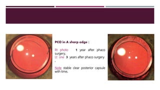 PCO in A sharp edge :
Rt photo 1 year after phaco
surgery.
Lt one 3 years after phaco surgery
.
Note stable clear posterior capsule
with time.
 