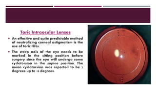 Toric Intraocular Lenses
 An effective and quite predictable method
of neutralizing corneal astigmatism is the
use of toric IOLs.
 The steep axis of the eye needs to be
marked in the sitting position before
surgery since the eye will undergo some
cyclotorsion in the supine position. The
mean cyclotorsion was reported to be 2
degrees up to 10 degrees.
 