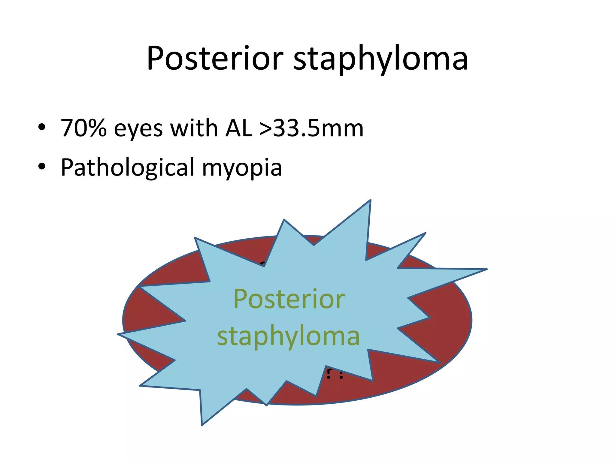 Posterior staphyloma
• 70% eyes with AL >33.5mm
• Pathological myopia
Difficulty in
obtaining posterior
retinal spike
????????
Posterior
staphyloma
 