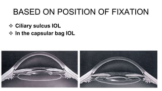 IOL IN CATARACT SURGERY.pptx