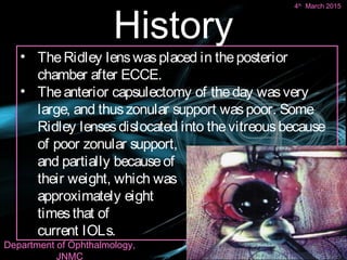 Iol master | PPT