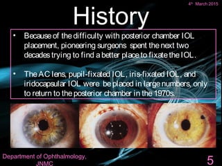 4th March 2015 5
• Becauseof thedifficulty with posterior chamber IOL
placement, pioneering surgeons spent thenext two
decadestrying to find abetter placeto fixatetheIOL.
• TheAC lens, pupil-fixated IOL, iris-fixated IOL, and
iridocapsular IOL were beplaced in largenumbers, only
to return to theposterior chamber in the1970s.
History
5
4th
March 2015
Department of Ophthalmology,
JNMC
 
