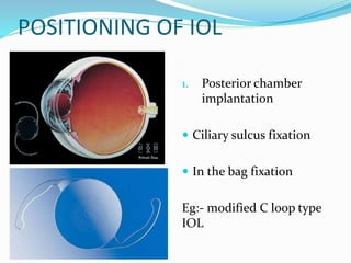 POSITIONING OF IOL
1. Posterior chamber
implantation
 Ciliary sulcus fixation
 In the bag fixation
Eg:- modified C loop type
IOL
 