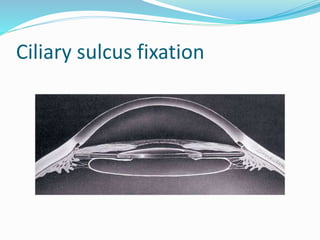 Ciliary sulcus fixation
 