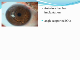 2. Anterior chamber
implantation
 angle supported IOLs
 