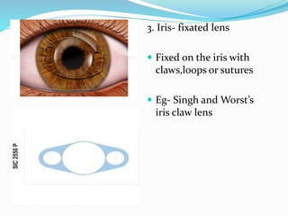 3. Iris- fixated lens
 Fixed on the iris with
claws,loops or sutures
 Eg- Singh and Worst’s
iris claw lens
 
