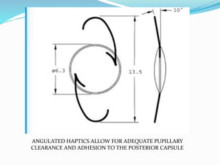 ANGULATED HAPTICS ALLOW FOR ADEQUATE PUPILLARY
CLEARANCE AND ADHESION TO THE POSTERIOR CAPSULE
 