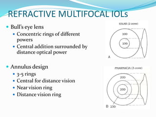REFRACTIVE MULTIFOCAL IOLs
 Bull’s eye lens
 Concentric rings of different
powers
 Central addition surrounded by
distance optical power
 Annulus design
 3-5 rings
 Central for distance vision
 Near vision ring
 Distance vision ring
 