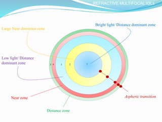 12345
Bright light/ Distance dominant zone
Large Near dominant zone
Low light/ Distance
dominant zone
Distance zone
Near zone Aspheric transition
REFRACTIVE MULTIFOCAL IOLs
 