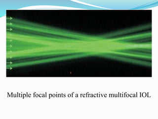 Multiple focal points of a refractive multifocal IOL
 