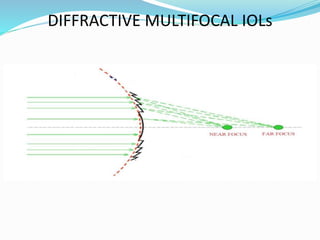 DIFFRACTIVE MULTIFOCAL IOLs
 