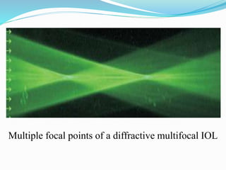Multiple focal points of a diffractive multifocal IOL
 
