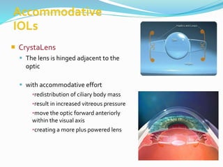  CrystaLens
 The lens is hinged adjacent to the
optic
 with accommodative effort
▪redistribution of ciliary body mass
▪result in increased vitreous pressure
▪move the optic forward anteriorly
within the visual axis
▪creating a more plus powered lens
 