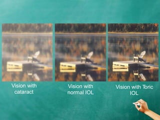 Vision with
cataract
Vision with
normal IOL
Vision with Toric
IOL
 