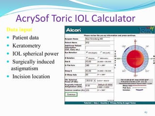 AcrySof Toric IOL Calculator
Data input
 Patient data
 Keratometry
 IOL spherical power
 Surgically induced
astigmatism
 Incision location
67
 