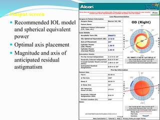 Output screen
 Recommended IOL model
and spherical equivalent
power
 Optimal axis placement
 Magnitude and axis of
anticipated residual
astigmatism
68
 
