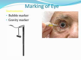 Marking of Eye
Instruments
• Bubble marker
• Gravity marker
 