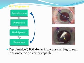 • IOL alignment
 Tap (“nudge”) IOL down into capsular bag to seat
lens onto the posterior capsule.
Gross alignment
OVD removal
Final alignment
If overshoots
 