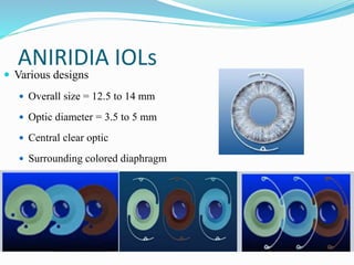 ANIRIDIA IOLs
 Various designs
 Overall size = 12.5 to 14 mm
 Optic diameter = 3.5 to 5 mm
 Central clear optic
 Surrounding colored diaphragm
 