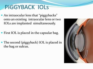 PIGGYBACK IOLs
 An intraocular lens that “piggybacks”
onto an existing intraocular lens or two
IOLs are implanted simultaneously.
 First IOL is placed in the capsular bag.
 The second (piggyback) IOL is placed in
the bag or sulcus.
 