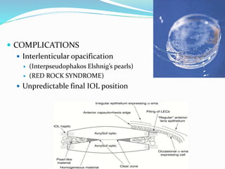  COMPLICATIONS
 Interlenticular opacification
 (Interpseudophakos Elshnig’s pearls)
 (RED ROCK SYNDROME)
 Unpredictable final IOL position
 