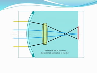 Conventional IOL increase
the spherical aberration of the eye
 
