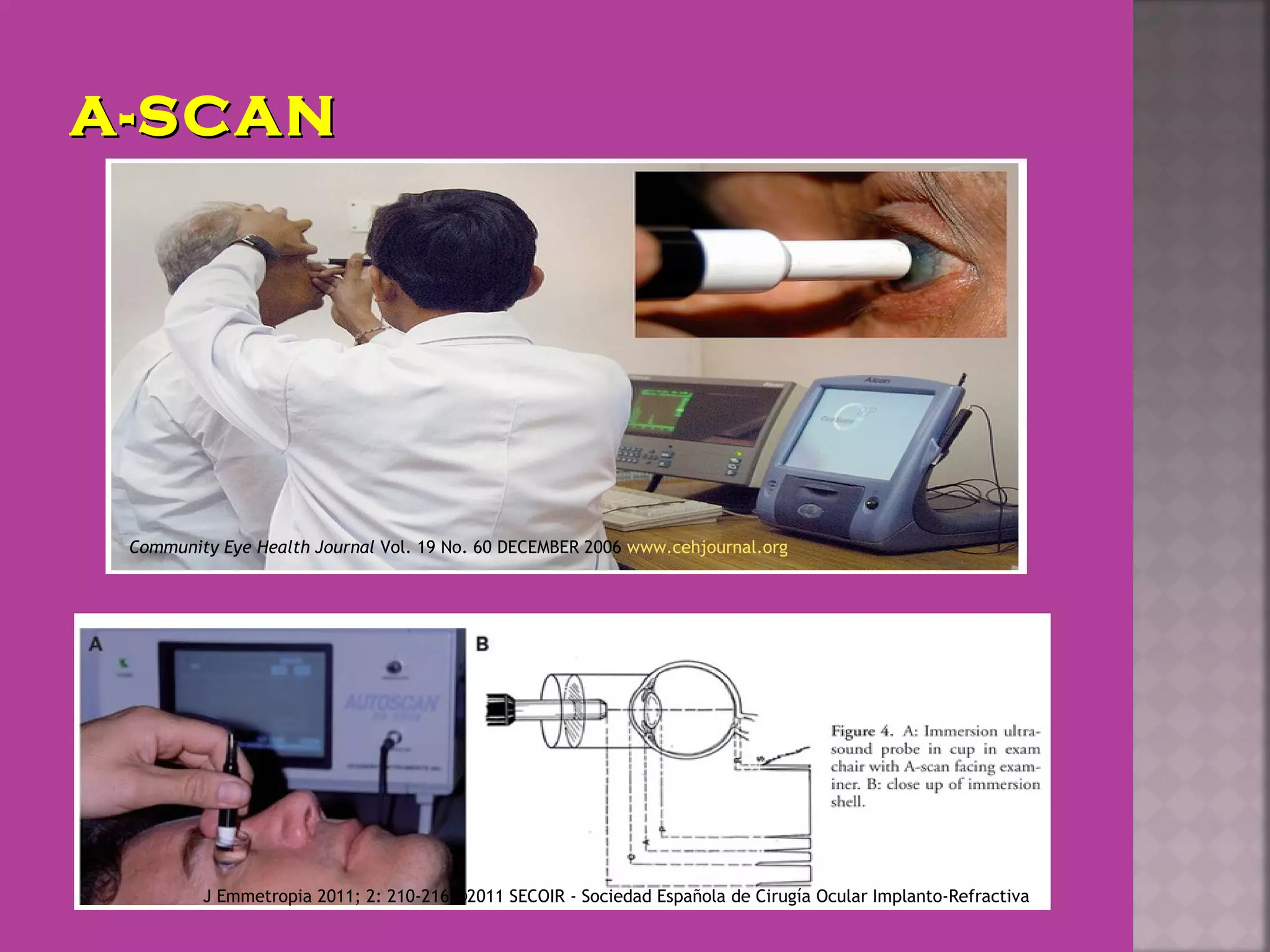 A-SCANA-SCAN
Community Eye Health Journal Vol. 19 No. 60 DECEMBER 2006 www.cehjournal.org
J Emmetropia 2011; 2: 210-216 ©2011 SECOIR - Sociedad Española de Cirugía Ocular Implanto-Refractiva
 
