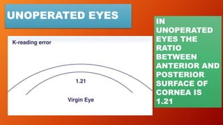 UNOPERATED EYES IN
UNOPERATED
EYES THE
RATIO
BETWEEN
ANTERIOR AND
POSTERIOR
SURFACE OF
CORNEA IS
1.21
 