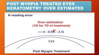 POST MYOPIA TREATED EYES
KERATOMETRY OVER ESTIMATED
 