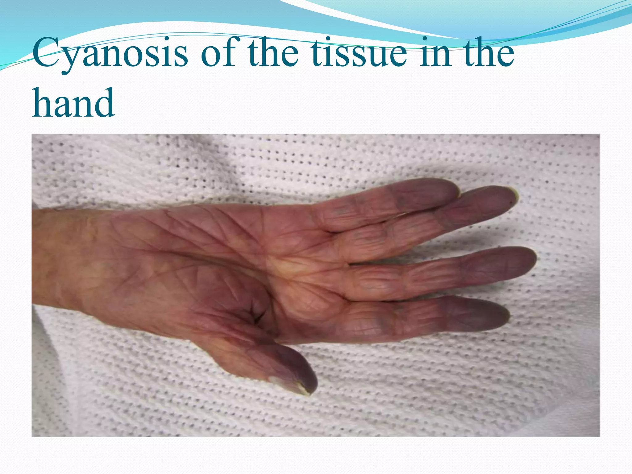 Cyanosis of the tissue in the
hand
 