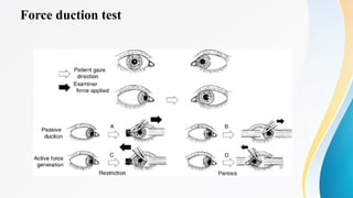 Ocular Motilit Ddisorders Ocular Motilit Ddisorders IOMD-ppt.pptx