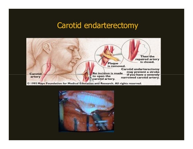 iom during carotid endarterectomy 2008 a carotid endarterectomy works to restore adequate blood flow to the
