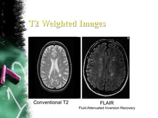 T2 Weighted Images
Conventional T2 FLAIR
Fluid Attenuated Inversion Recovery
 