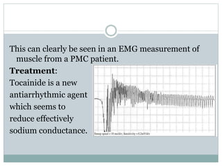 This can clearly be seen in an EMG measurement of 
muscle from a PMC patient. 
Treatment: 
Tocainide is a new 
antiarrhythmic agent 
which seems to 
reduce effectively 
sodium conductance. 
 