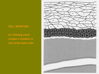 CELL INITIATION 
An initiating event 
creates a mutation in 
one of the basal cells 
 