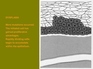 DYSPLASIA 
More mutations occurred. 
The initiated cell has 
gained proliferative 
advantages. 
Rapidly dividing cells 
begin to accumulate 
within the epithelium. 
 